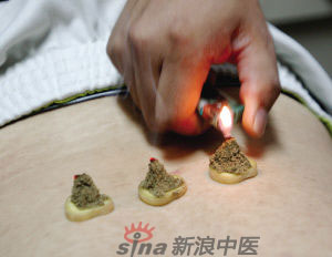 灸法的種類  你知道多少？